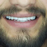 کامپوزیت دندان کامپوزیت زیبایی  ایمپلنت  لمینیت|خدمات آرایشگری و زیبایی|لیسار, |دیوار
