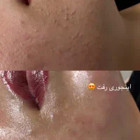 پاکسازی و فیشیال پوست