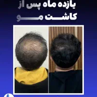 کاشت مو بدون جراحی یک روزه ضمانت مادام العمر|خدمات آرایشگری و زیبایی|تهران, ونک|دیوار