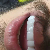 عصبکشی پر کردن ۱۳۰۰ روکش فروش رادیوگرافی|خدمات آرایشگری و زیبایی|مرند, |دیوار