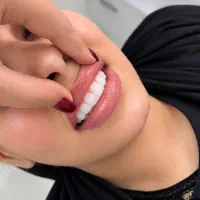 تخفیف کامپوزیت سولافیل با شرایط اقساطی