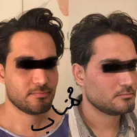 . تزریق چربی توسط پزشک