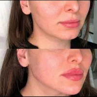آموزش ژل فیلر لب چانه انزیم چاقی صورت مزو مو فشیال|خدمات آرایشگری و زیبایی|قم, زنبیل آباد|دیوار
