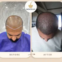 کاشت مو فقط با پرداخت ۱۰ میلیون|خدمات آرایشگری و زیبایی|تهران, جردن|دیوار