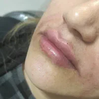 تزریق ژل و بوتاکس|خدمات آرایشگری و زیبایی|اصفهان, گلزار|دیوار