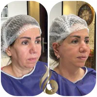 تخفیف ۵۰ درصدی مکس لیفت، لیفت شقیقه، دایرکت ابرو