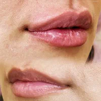 تخفیفات ویژه بوتاکس، فیلر، ژل لب، prp توسط پزشک|خدمات زیبایی و سلامت|مشهد, احمدآباد|دیوار