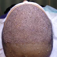 کاشت مو با تخفیف ویژه تابستانی