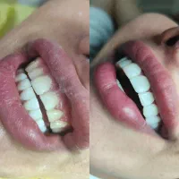 آموزش کامپوزیت دندان ،بیلیچینگ ،لمیمنت روکش دندان|خدمات آرایشگری و زیبایی|کرج, چهارصد دستگاه|دیوار