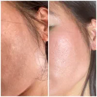 مزونیدلینگ و مزوتراپی صورت و مو|خدمات آرایشگری و زیبایی|یاسوج, |دیوار