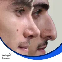 تخفیف بی نظیر عمل بینی