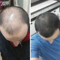 درمان تخصصی طاسی و کم‌پشتی