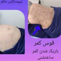 تخلیه وتزریق چربی لابیا جراحی پلک دایرکت اتوپلاستی|خدمات آرایشگری و زیبایی|دورود, |دیوار