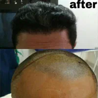 کاشت مو، ابرو، ریش حرفه ای توسط پزشک متخصص پوست مو|خدمات آرایشگری و زیبایی|شیراز, قدوسی غربی|دیوار