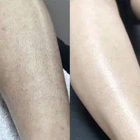لیزرموی زاید کندلا، شاتی بدون تماس با بدن|خدمات آرایشگری و زیبایی|یاسوج, |دیوار