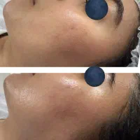 پاکسازی و فیشال،فیشیال پوست به سبک مدرن