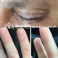 بهبود زگیل/تبخال/hpv/hsv|آرایشی، بهداشتی، درمانی|قم, یخچال قاضی|دیوار