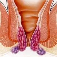 بهبودیبوست وبواسیر