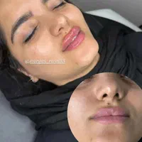 آموزش فیلر چونه بوتاکس ژل لب مزوژل پرسینگ|خدمات آرایشگری و زیبایی|مشهد, موسوی قوچانی|دیوار