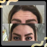 جشنواره تابستانه تخفیفی بوتاکس