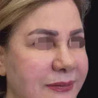 تزریق ژل وبوتاکیس