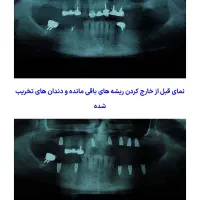 تخفیف ویژه ده روزه ایمپلنت