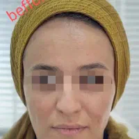 بوتاکس رایگان با انجام دو سی سی فیلر پیروزی|خدمات آرایشگری و زیبایی|تهران, چهارصد دستگاه|دیوار