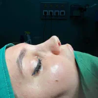 رینوپلاستی