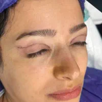 فیلر سی سی۳۳۰ بلفاروپلاستی ۶/۹۰۰ بوتاکس ۲۵۰|خدمات آرایشگری و زیبایی|تهران, صادقیه|دیوار