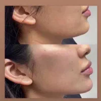 مدل لیفت صورت و ابرو با نخ توسط پزشک در کلینیک|خدمات آرایشگری و زیبایی|تهران, علم و صنعت|دیوار