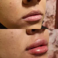 تخفیف ۵۰درصدی ژل وبوتاکس ومزو