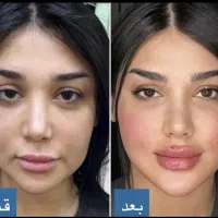 بوتاکس،فیلر، ژل ،ریموو تتو|خدمات زیبایی و سلامت|کرمانشاه, |دیوار