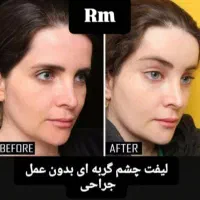 تزریق بوتاکس و لیفت چشم گربه ای  جدیدترین متد|خدمات آرایشگری و زیبایی|ری, دیلمان|دیوار