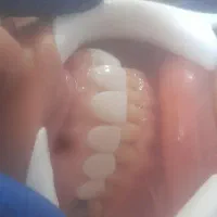 کاشت پرکردن ترمیم رفع پوسیدگی کامپوزیت مدل|خدمات آرایشگری و زیبایی|اهواز, کیانپارس |دیوار