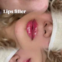 جشنواره تخفیفی ژل و بوتاکس/وام/اقساطی|خدمات آرایشگری و زیبایی|ساری, |دیوار