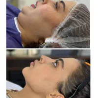 ساکشن غبغب۲۹۰۰و کربن تراپی۳۸۰و پی آر پی۳۸۰(اقساطی)