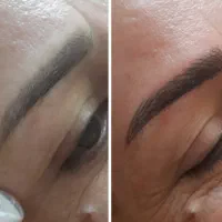 مدل برای فیبروز و خاویار تراپی