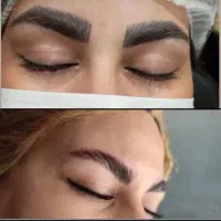 کیوسوئیچ تاتوقدیمی و لیزر  ردبخیه و لک.کربن تراپی