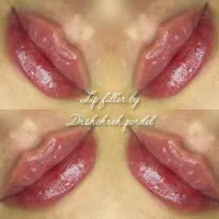 جشنواره زیبایی تزریق ژل و بوتاکس