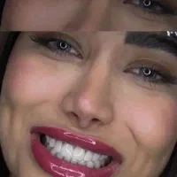 تخفیف ویژه کامپوزیت دندان ژل و بوتاکس قیمتها واقعی