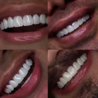 لمینت دندان،کامپوزیت دندان،روکش دندان