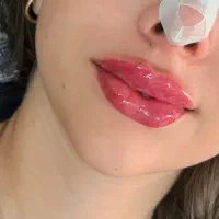 تخفیف ویژه ژل و بوتاکس