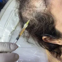 درمان ریزش مو در کلینیک دکتر علی بابایی