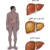 پاکسازی کبد چرب|آرایشی، بهداشتی، درمانی|گنبد کاووس, |دیوار