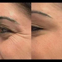 جشنواره تخفیف تزریق تخصصی ژل و بوتاکس|خدمات آرایشگری و زیبایی|شیراز, محراب|دیوار