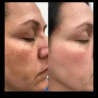 کرم سفید کننده شب (آنتی استاین )ترکیب آمپولی|آرایشی، بهداشتی، درمانی|بم, |دیوار