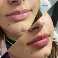 جشنواره تزریق ژل و بوتاکس (تحت نظرپزشک)|خدمات آرایشگری و زیبایی|اصفهان, خلجا|دیوار