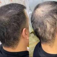 جدیدترین متد افزایش رشد مو