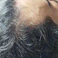 درمان ریزش مو|خدمات آرایشگری و زیبایی|رشت, بلوار گیلان|دیوار