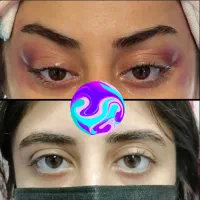 جراحی پلک ولیفت ابرو،تزریق فیلر و بوتاکس